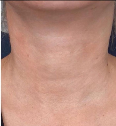 بعد - تجديد وشد الرقبة
